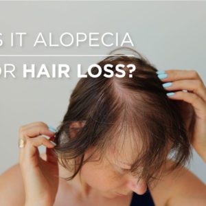alopecia or hair loss