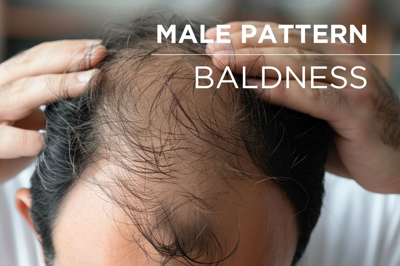 How to Deal with Male Pattern Baldness